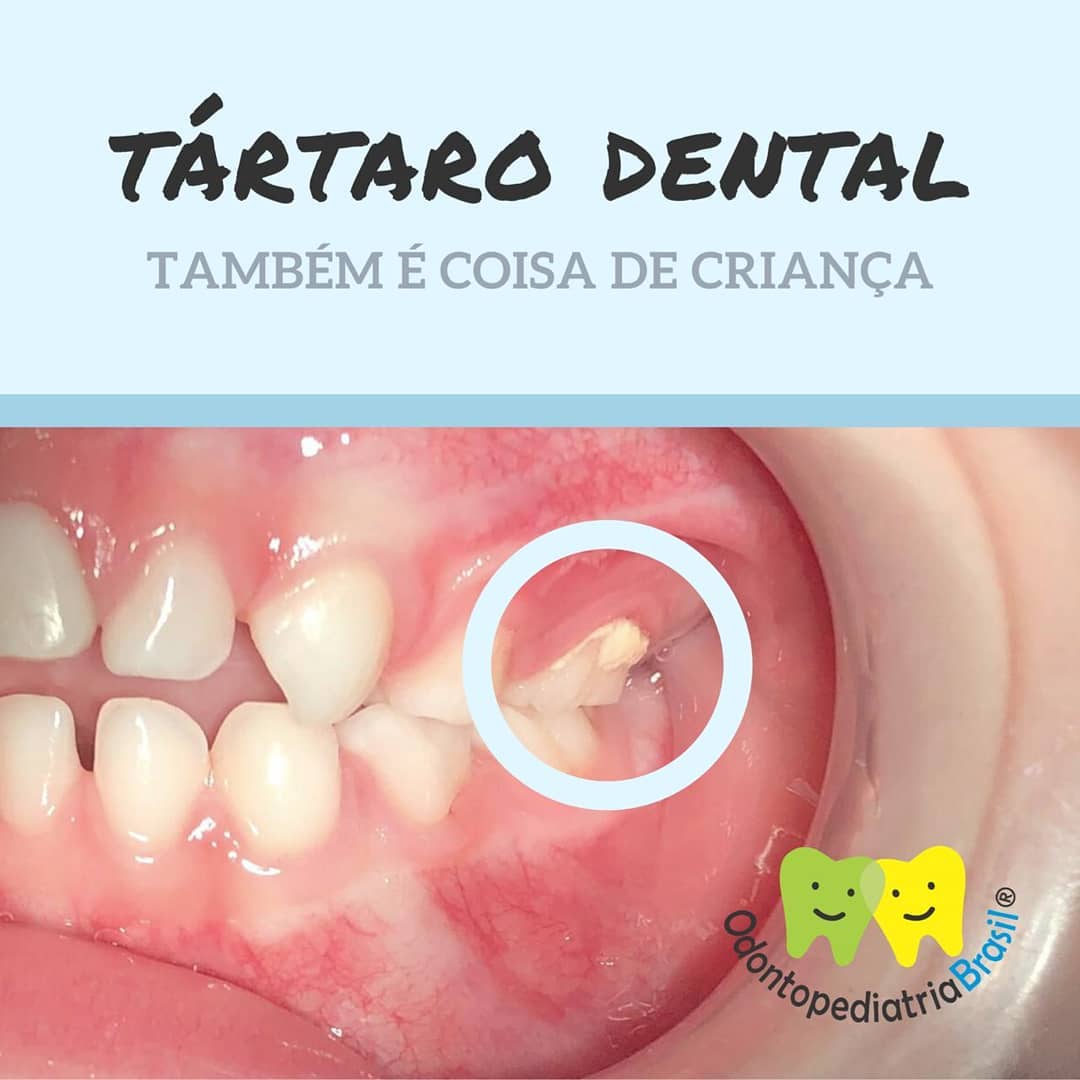 TÁRTARO DENTAL