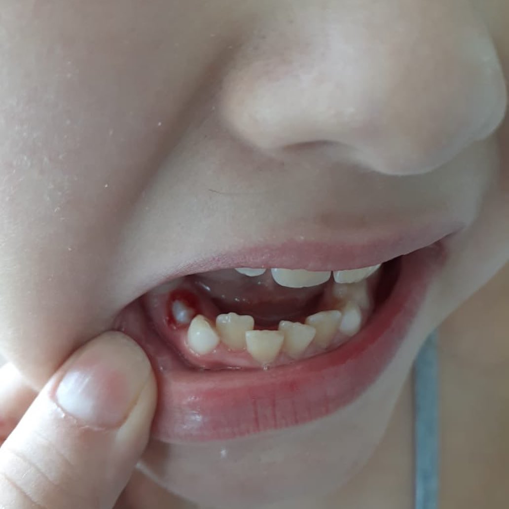 DENTE DE MUMMERY