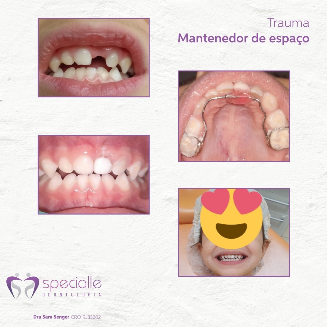 JÁ OUVIU FALAR EM MANTENEDOR DE ESPAÇO?