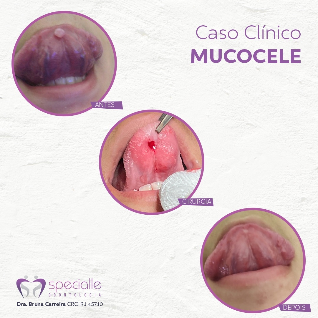 MUCOCELE
