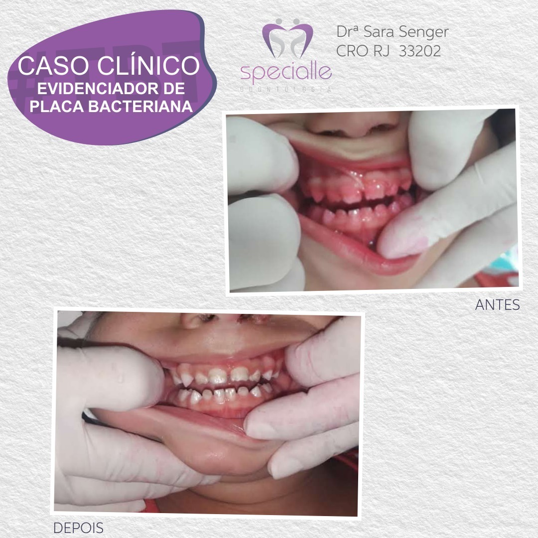EVIDENCIADOR DE PLACA BACTERIANA