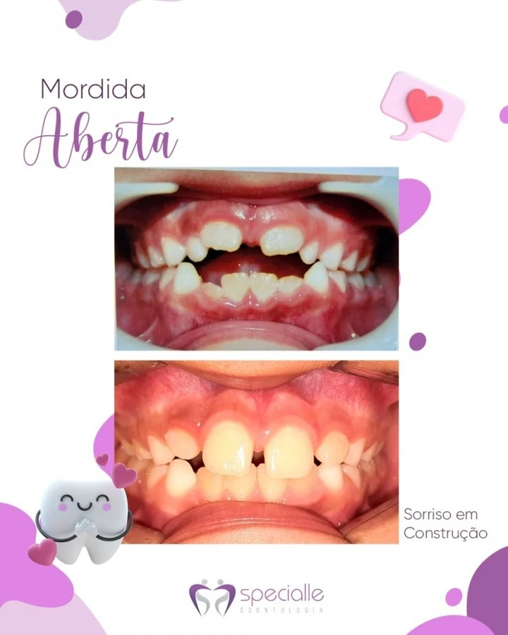 MORDIDA ABERTA