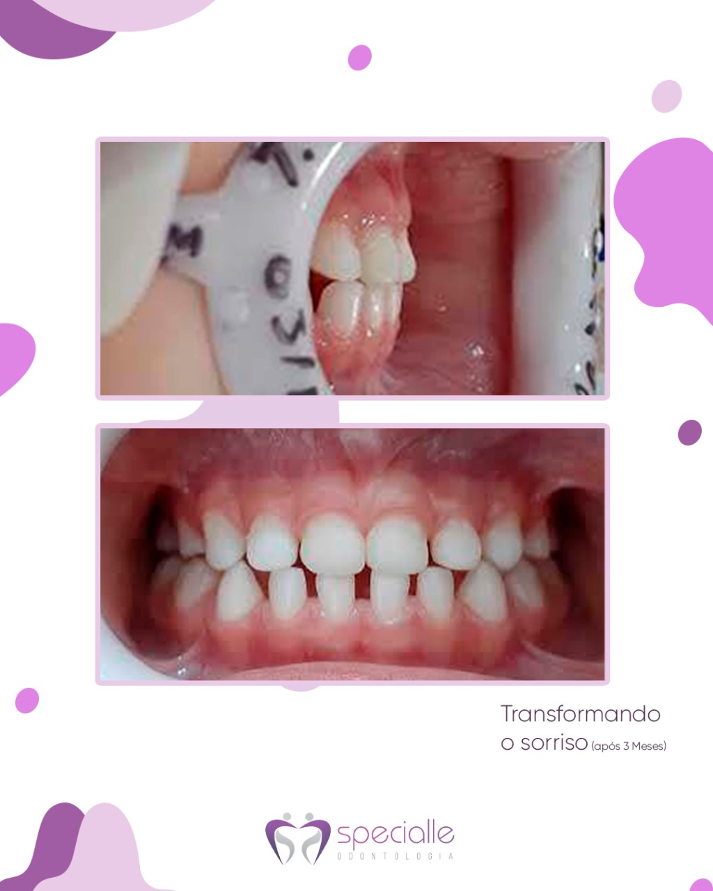 Mordida cruzada anterior