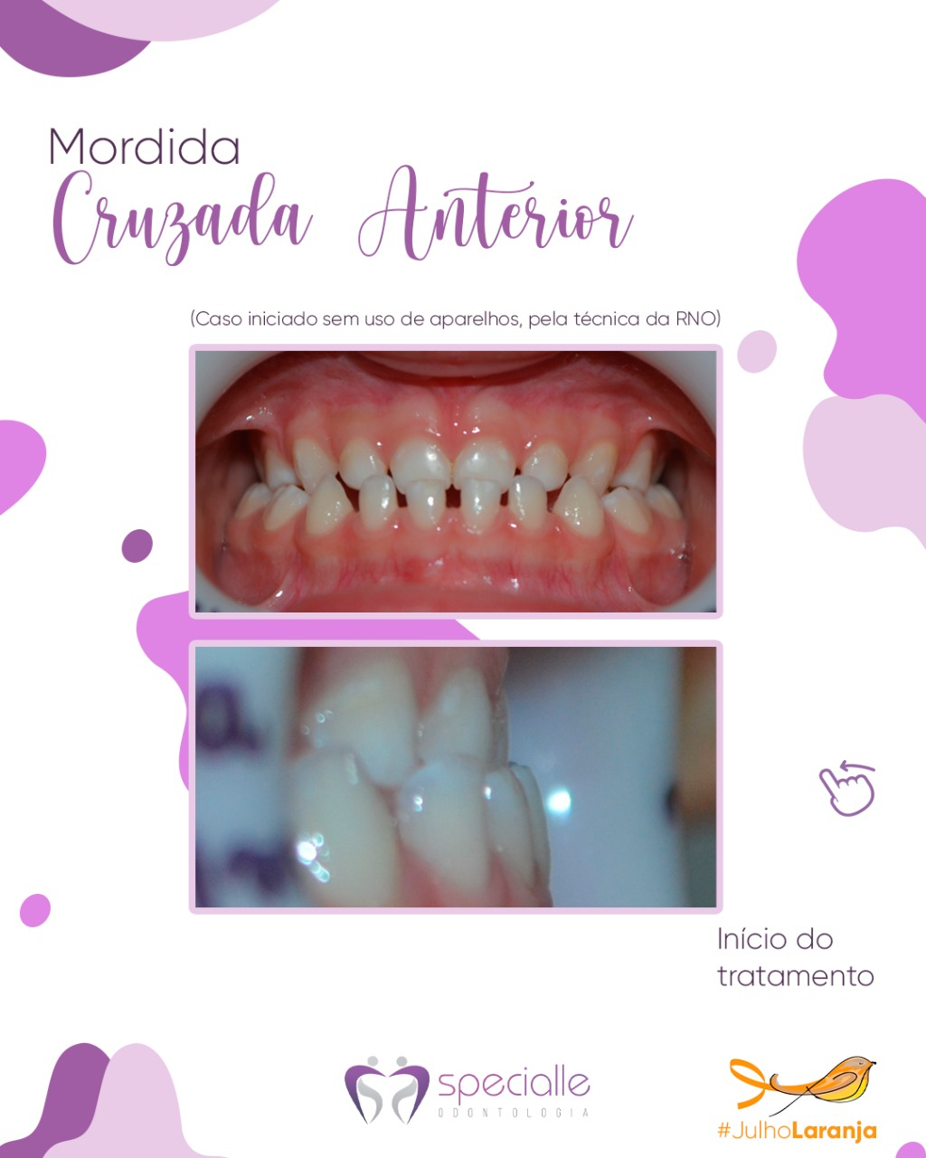 PACIENTE COM MORDIDA CRUZADA ANTERIOR