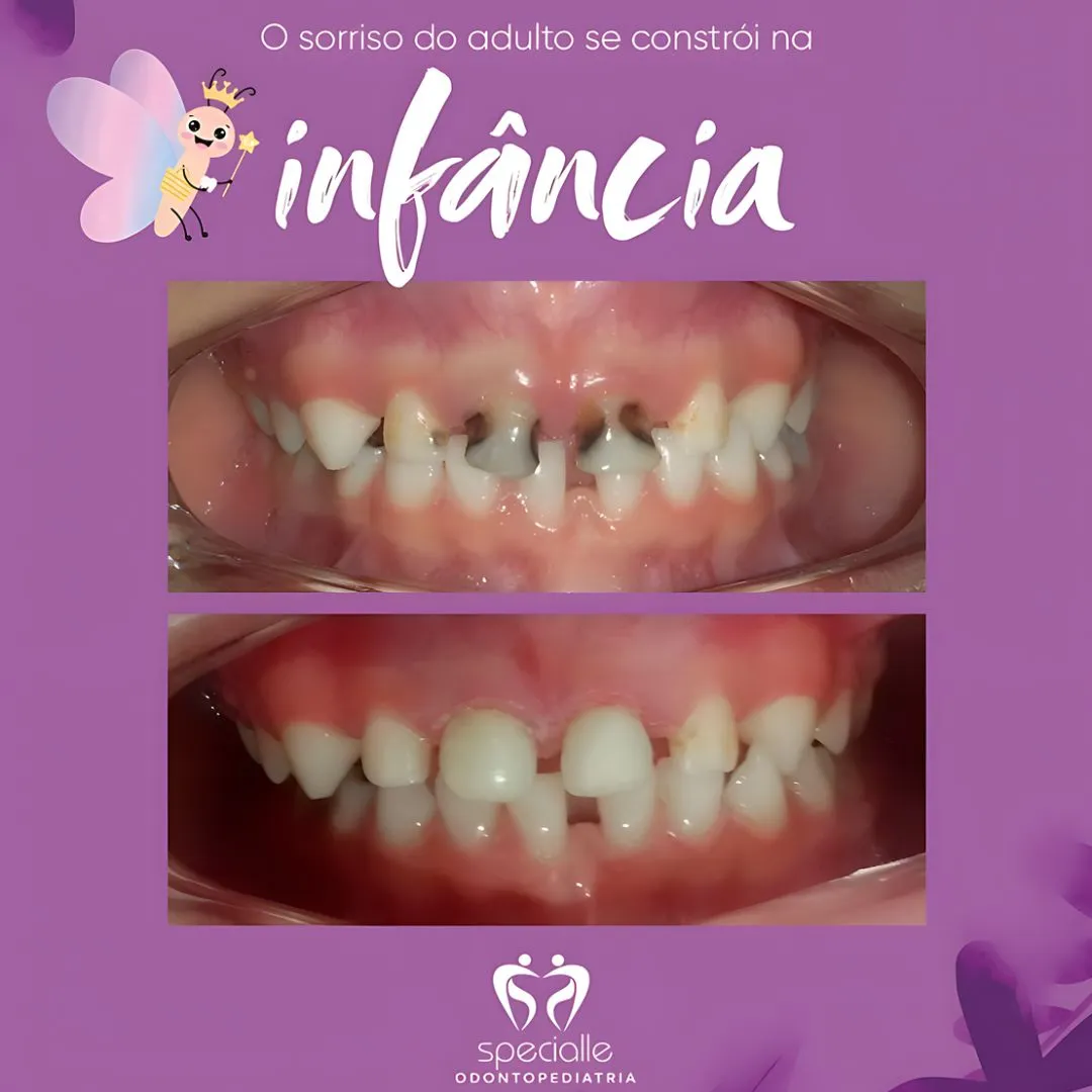 CÁRIE NA INFÂNCIA 