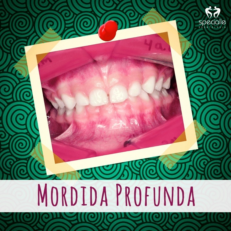 MORDIDA PROFUNDA 