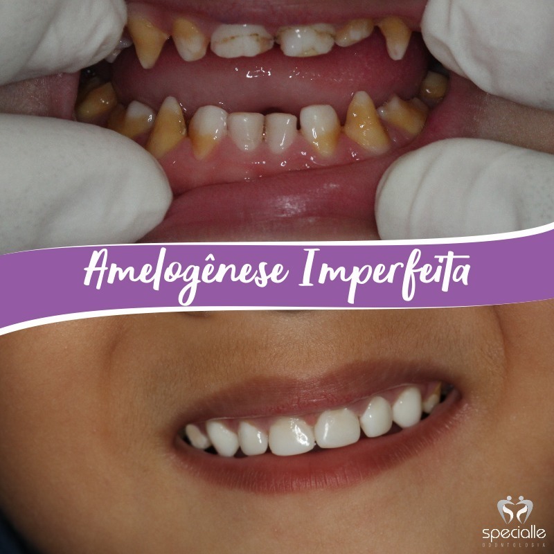 AMELOGÊNESE IMPERFEITA