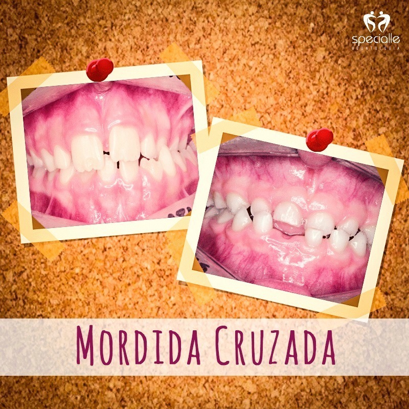 MORDIDA CRUZADA